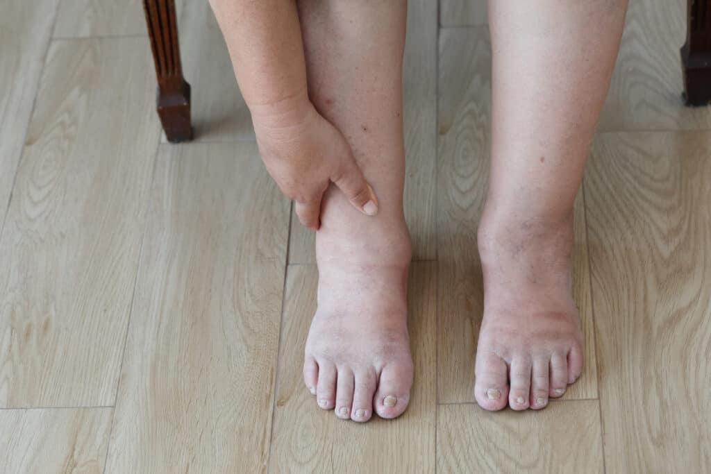 Woman with swollen feet and legs